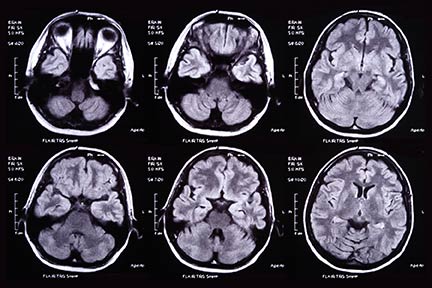 Moderate to severe brain injury can be seen on MRI and CT images. Akron brain injury law firms and lawyers can help arrange appropriate medical experts and doctors to properly diagnose and prove your head trauma or traumatic brain injury to a court.